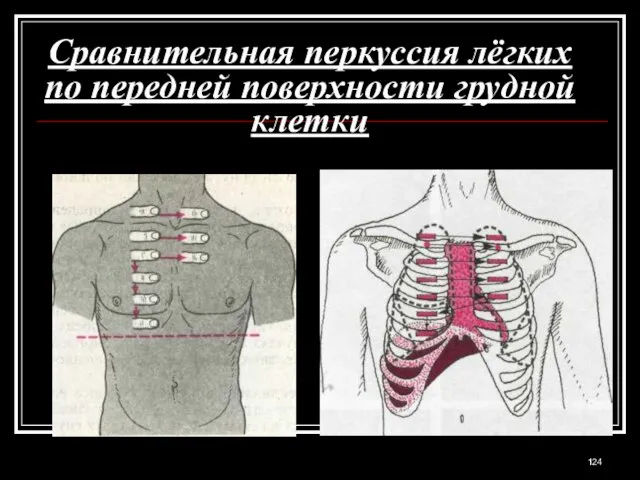 Сравнительная перкуссия лёгких по передней поверхности грудной клетки