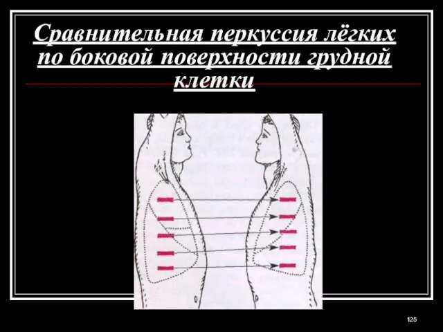 Сравнительная перкуссия лёгких по боковой поверхности грудной клетки