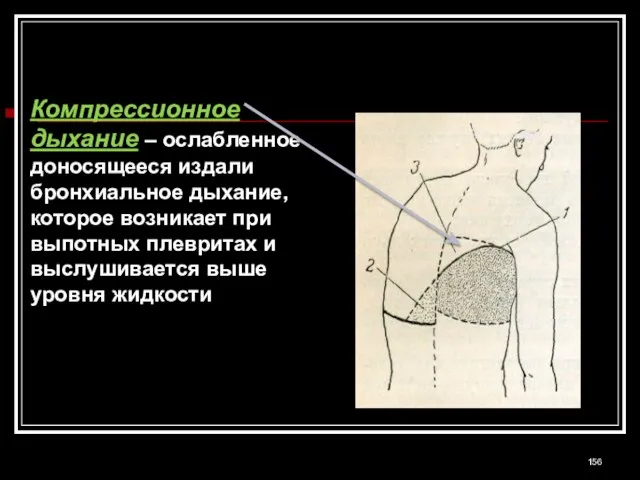 Компрессионное дыхание – ослабленное доносящееся издали бронхиальное дыхание, которое возникает при выпотных