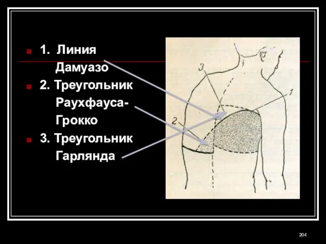 1. Линия Дамуазо 2. Треугольник Раухфауса- Грокко 3. Треугольник Гарлянда