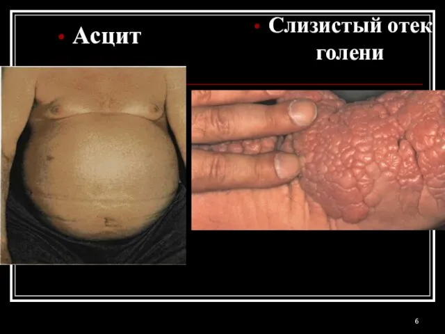 Асцит Слизистый отек голени