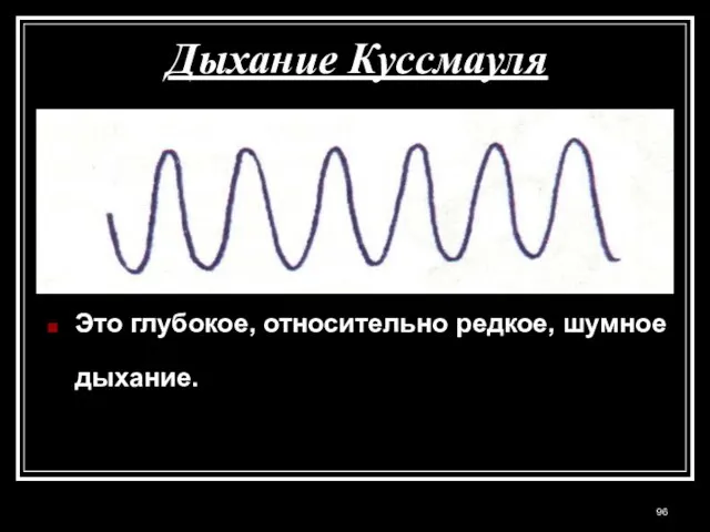 Дыхание Куссмауля Это глубокое, относительно редкое, шумное дыхание.