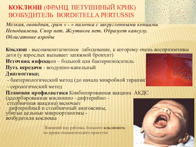 КОКЛЮШ (ФРАНЦ. ПЕТУШИНЫЙ КРИК) ВОЗБУДИТЕЛЬ BORDETELLA PERTUSSIS Мелкая, овоидная, грам « -