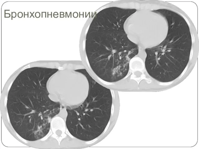 Бронхопневмонии