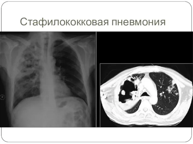Стафилококковая пневмония
