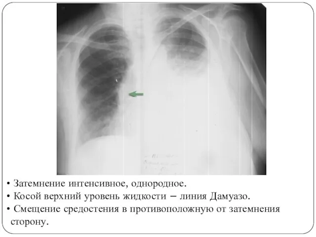 Затемнение интенсивное, однородное. Косой верхний уровень жидкости – линия Дамуазо. Смещение средостения