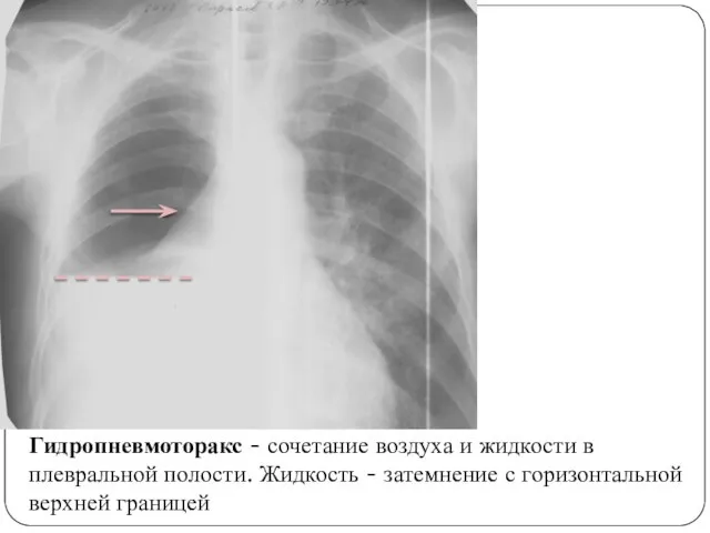 Гидропневмоторакс - сочетание воздуха и жидкости в плевральной полости. Жидкость - затемнение с горизонтальной верхней границей