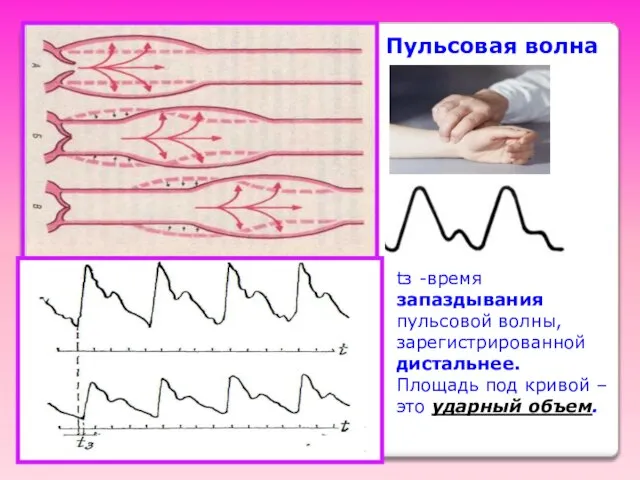 tз -время запаздывания пульсовой волны, зарегистрированной дистальнее. Площадь под кривой – это ударный объем. Пульсовая волна