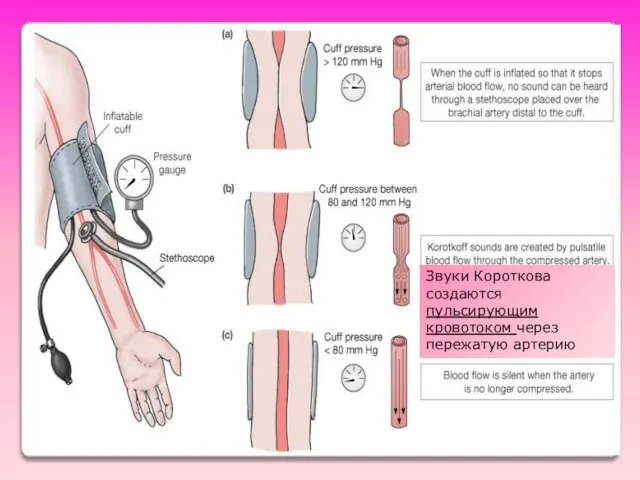 Звуки Короткова создаются пульсирующим кровотоком через пережатую артерию