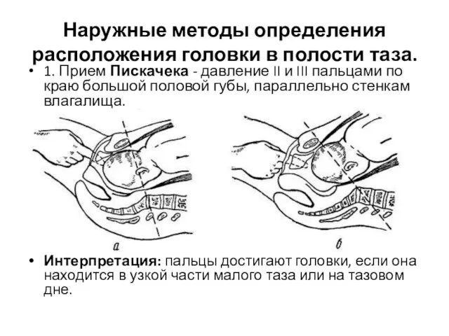 Наружные методы определения расположения головки в полости таза. 1. Прием Пискачека -