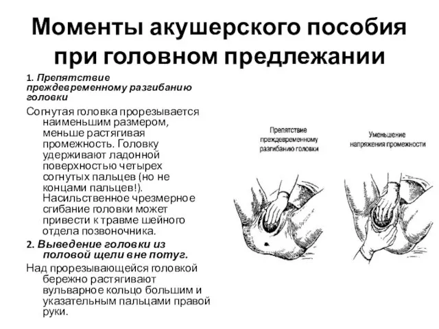 Моменты акушерского пособия при головном предлежании 1. Препятствие преждевременному разгибанию головки Согнутая