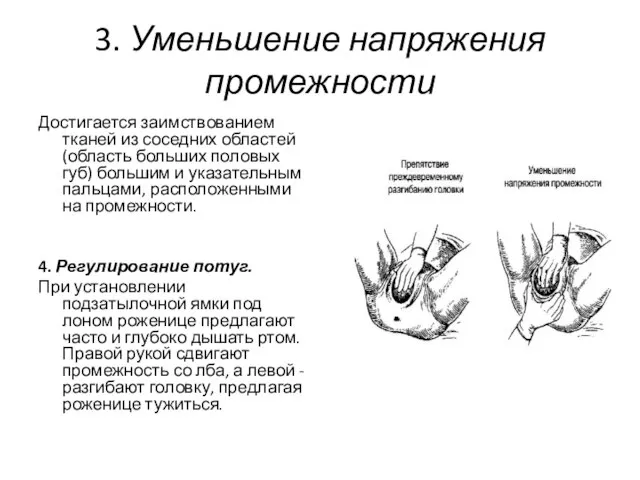 3. Уменьшение напряжения промежности Достигается заимствованием тканей из соседних областей (область больших