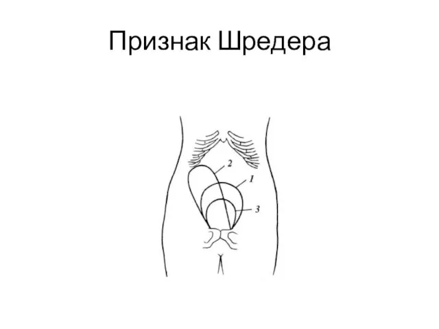 Признак Шредера