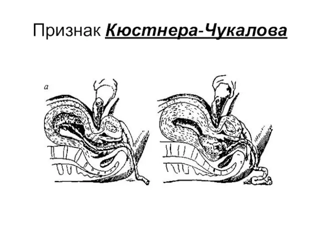 Признак Кюстнера-Чукалова