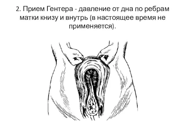 2. Прием Гентера - давление от дна по ребрам матки книзу и