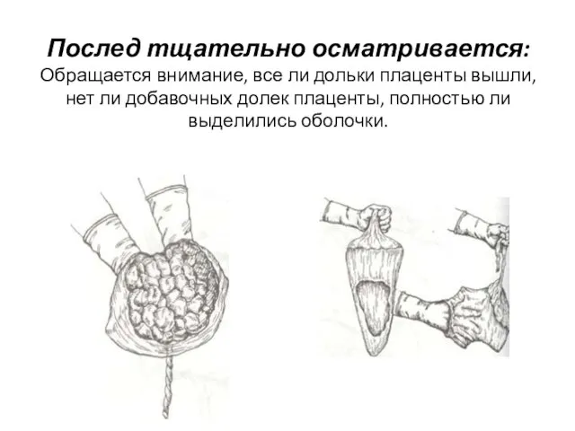 Послед тщательно осматривается: Обращается внимание, все ли дольки плаценты вышли, нет ли