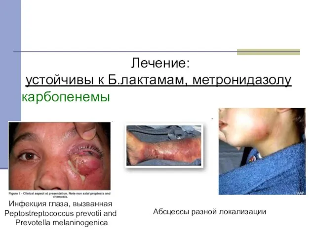 Инфекция глаза, вызванная Peptostreptococcus prevotii and Prevotella melaninogenica Лечение: устойчивы к Б.лактамам,