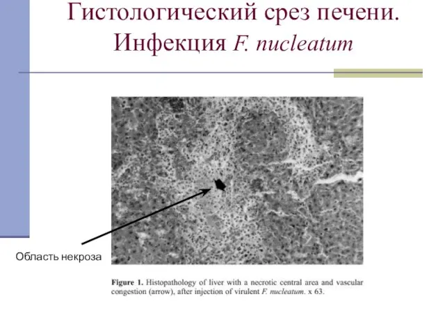 Гистологический срез печени. Инфекция F. nucleatum Область некроза