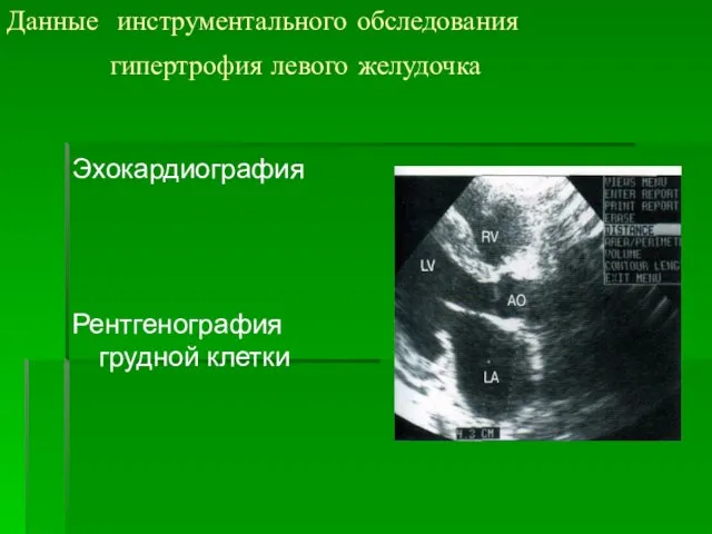 Данные инструментального обследования гипертрофия левого желудочка Эхокардиография Рентгенография грудной клетки