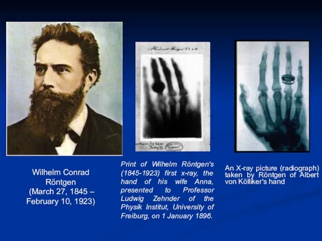 An X-ray picture (radiograph) taken by Röntgen of Albert von Kölliker's hand