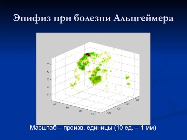 Эпифиз при болезни Альцгеймера Масштаб – произв. единицы (10 ед. – 1 мм)