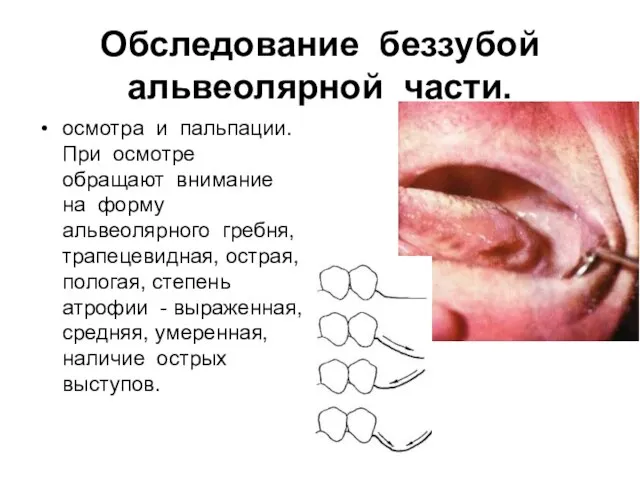 Обследование беззубой альвеолярной части. осмотра и пальпации. При осмотре обращают внимание на