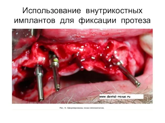 Использование внутрикостных имплантов для фиксации протеза