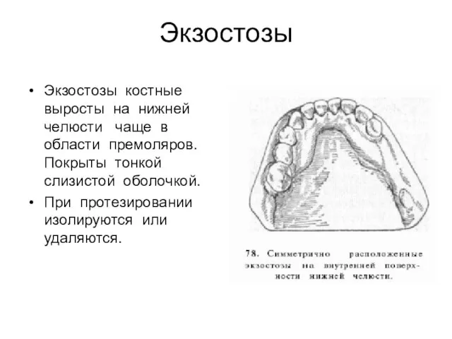 Экзостозы Экзостозы костные выросты на нижней челюсти чаще в области премоляров. Покрыты