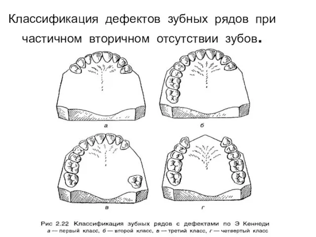 Классификация дефектов зубных рядов при частичном вторичном отсутствии зубов.