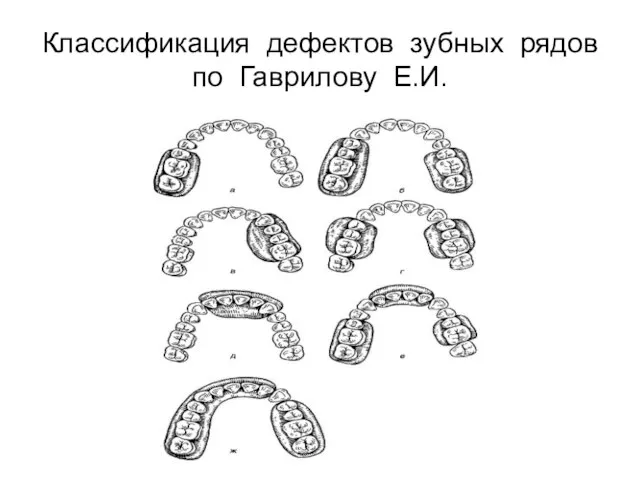 Классификация дефектов зубных рядов по Гаврилову Е.И.