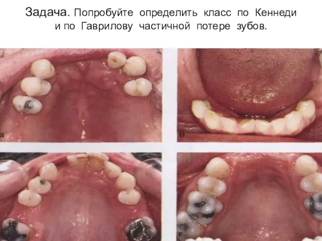 Задача. Попробуйте определить класс по Кеннеди и по Гаврилову частичной потере зубов.