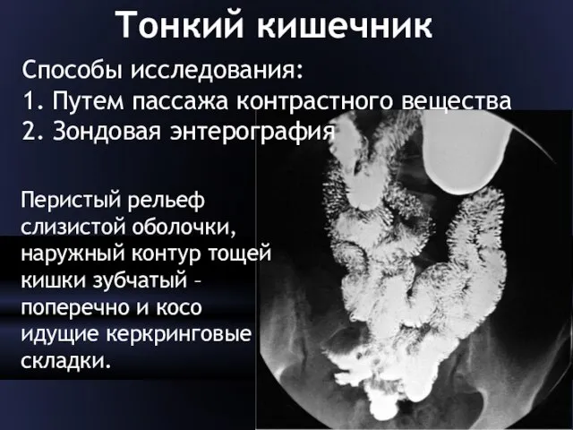 Тонкий кишечник Способы исследования: 1. Путем пассажа контрастного вещества 2. Зондовая энтерография