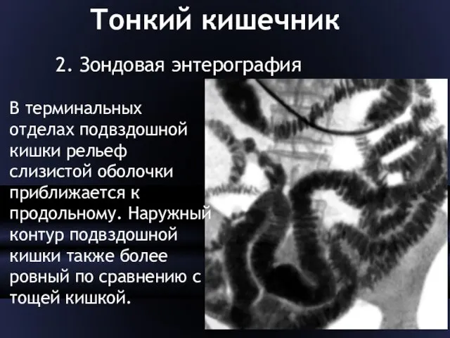 Тонкий кишечник 2. Зондовая энтерография В терминальных отделах подвздошной кишки рельеф слизистой