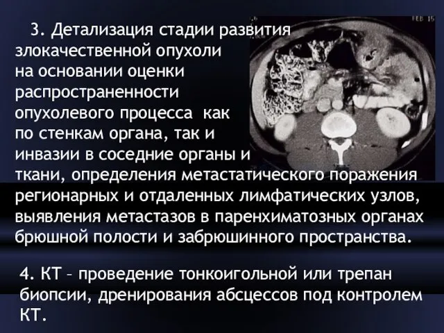 3. Детализация стадии развития злокачественной опухоли на основании оценки распространенности опухолевого процесса