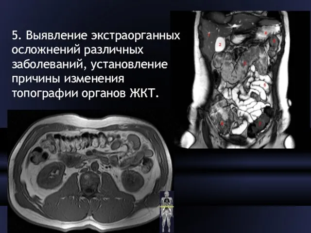 5. Выявление экстраорганных осложнений различных заболеваний, установление причины изменения топографии органов ЖКТ.