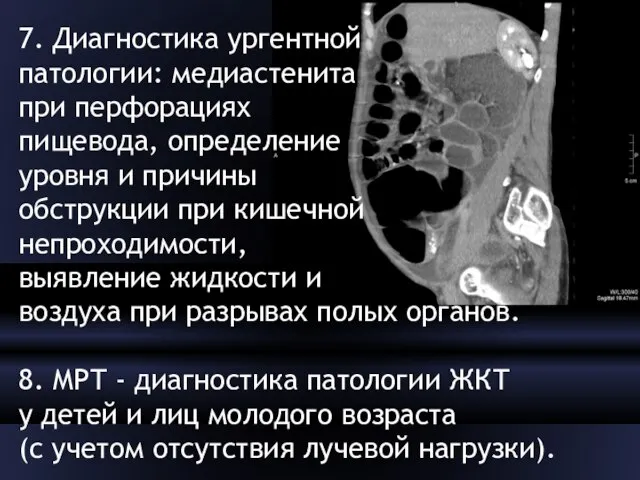 7. Диагностика ургентной патологии: медиастенита при перфорациях пищевода, определение уровня и причины