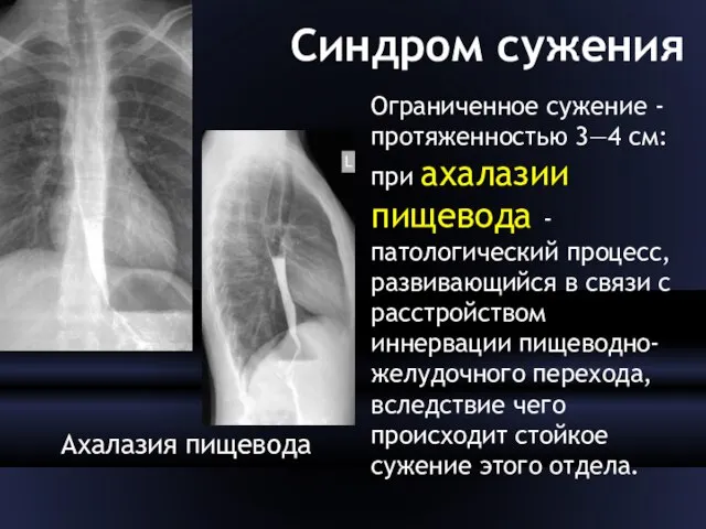 Синдром сужения Ахалазия пищевода Ограниченное сужение - протяженностью 3—4 см: при ахалазии