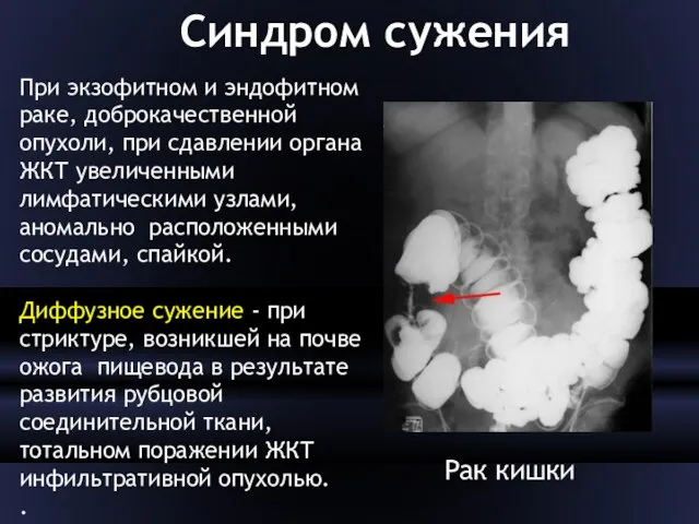 Синдром сужения При экзофитном и эндофитном раке, доброкачественной опухоли, при сдавлении органа