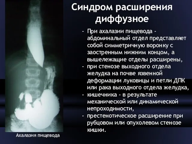 Синдром расширения диффузное Ахалазия пищевода При ахалазии пищевода - абдоминальный от­дел представляет