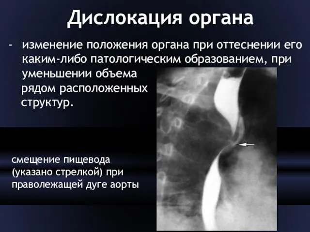 Дислокация органа изменение положения органа при оттеснении его каким-либо патологическим образованием, при