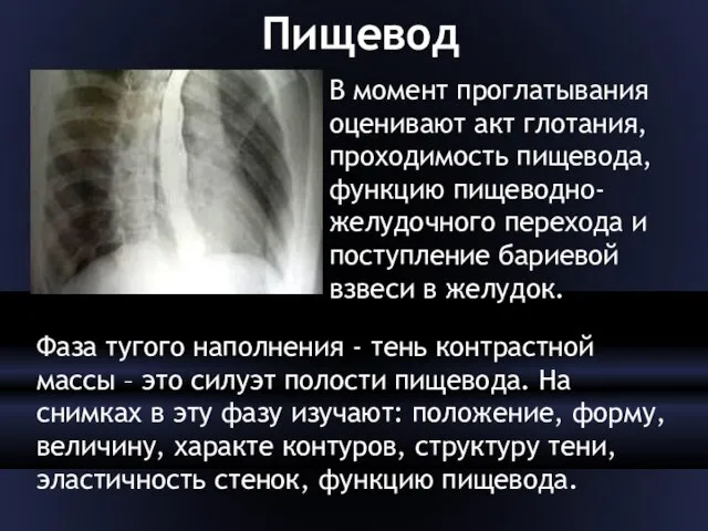 Пищевод В момент проглатывания оценивают акт глотания, проходимость пищевода, функцию пищеводно-желудочного перехода