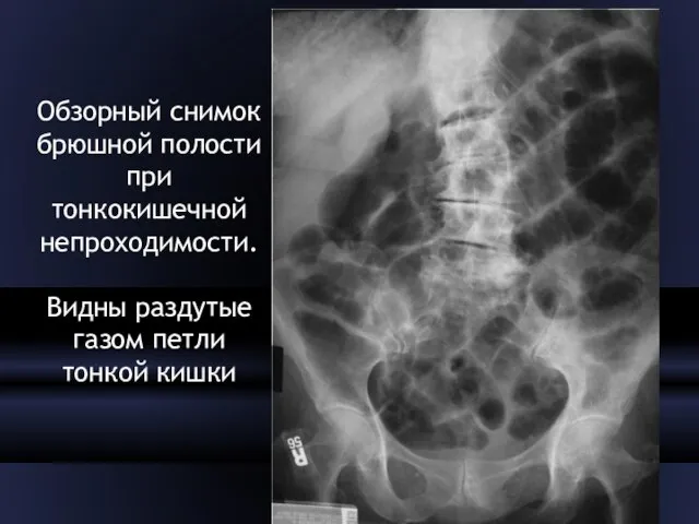 Обзорный снимок брюшной полости при тонкокишечной непроходимости. Видны раздутые газом петли тонкой кишки