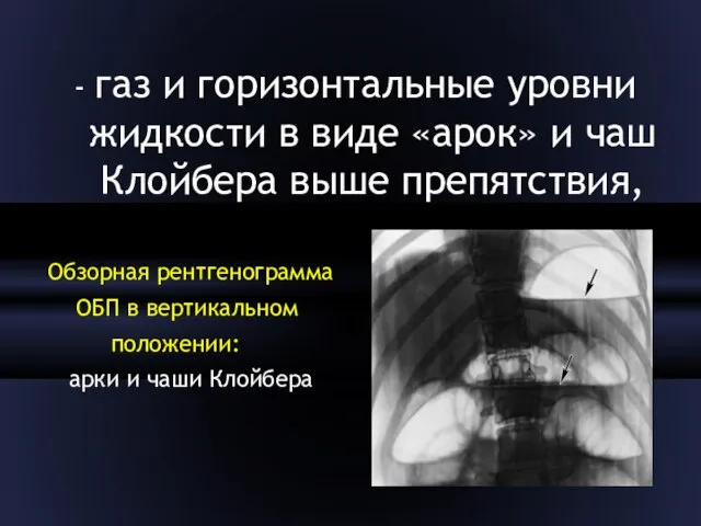 - газ и горизонтальные уровни жидко­сти в виде «арок» и чаш Клойбера