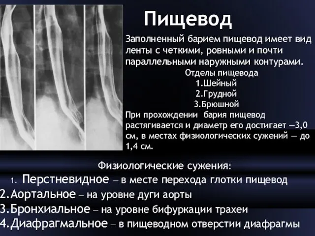 Пищевод Заполненный барием пищевод имеет вид ленты с четкими, ровными и почти