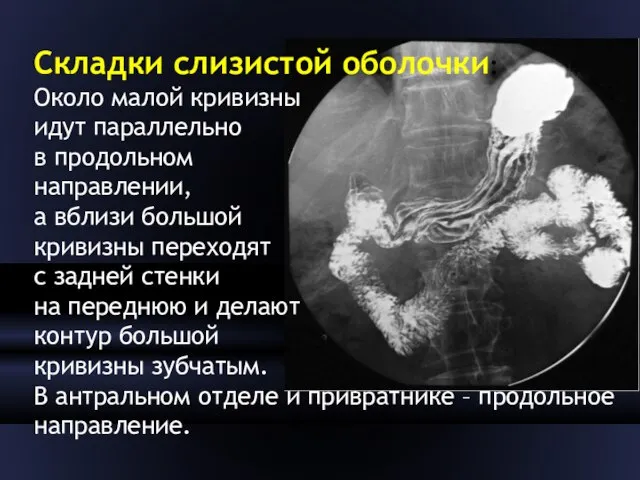 Складки слизистой оболочки: Около малой кривизны идут параллельно в продольном направлении, а