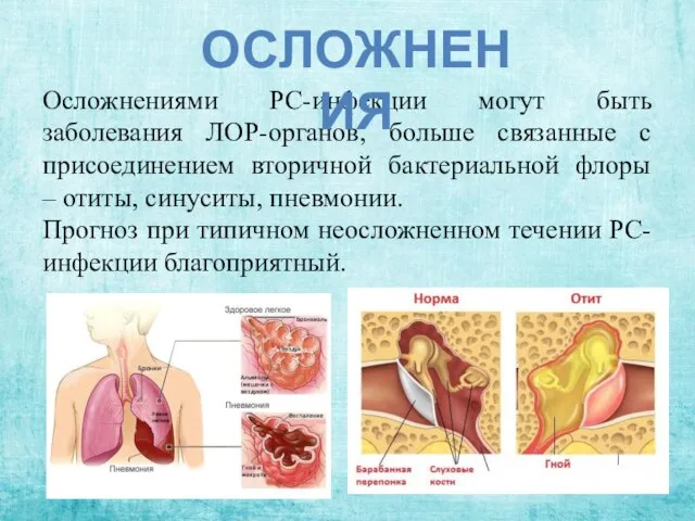 Осложнениями РС-инфекции могут быть заболевания ЛОР-органов, больше связанные с присоединением вторичной бактериальной