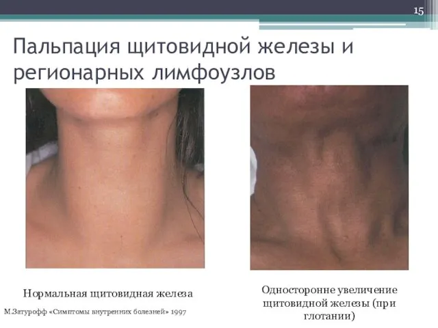 Пальпация щитовидной железы и регионарных лимфоузлов Нормальная щитовидная железа Односторонне увеличение щитовидной