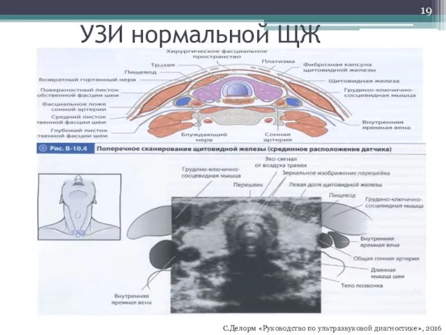 УЗИ нормальной ЩЖ С.Делорм «Руководство по ультразвуковой диагностике», 2016