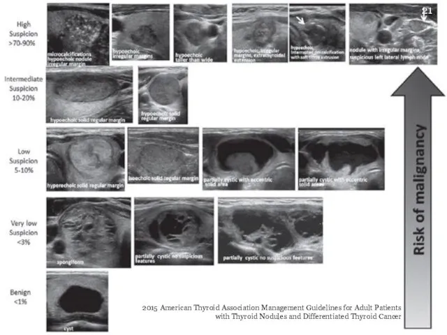 2015 American Thyroid Association Management Guidelines for Adult Patients with Thyroid Nodules and Differentiated Thyroid Cancer