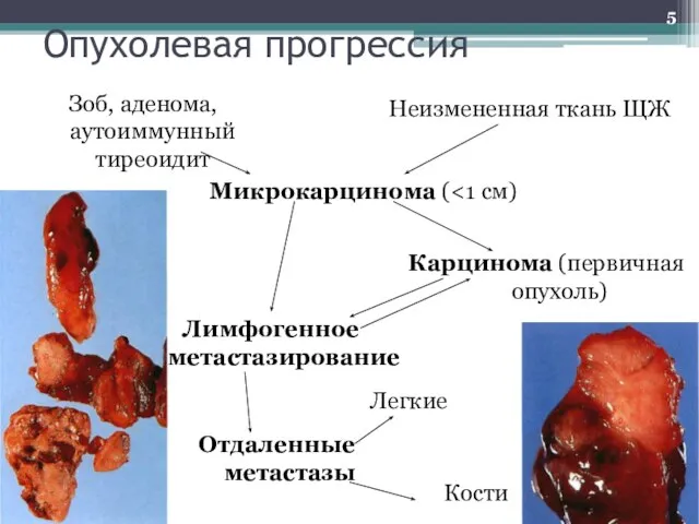 Опухолевая прогрессия Зоб, аденома, аутоиммунный тиреоидит Неизмененная ткань ЩЖ Микрокарцинома ( Карцинома